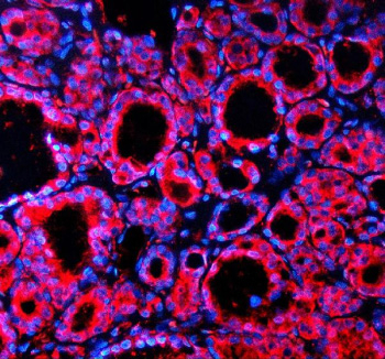 Immunofluorescent staining of SPOCK1 using anti-SPOCK1 antibody (red). SPOCK1 was detected in a paraffin-embedded section of human thyroid cancer tissue. Heat mediated antigen retrieval was performed in EDTA buffer (pH 8.0, epitope retrieval solution). The tissue section was blocked with 10% goat serum. The tissue section was then incubated with 5 ug/ml rabbit anti-SPOCK1 antibody overnight at 4oC. Cy3 Conjugated Goat Anti-Rabbit IgG was used as secondary antibody at 1:500 dilution and incubated for 30 minutes at 37oC. The section was counterstained with DAPI nuclear stain (blue). Visualize using a fluorescence microscope and filter sets appropriate for the label used.
