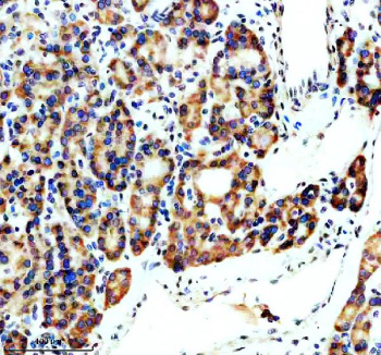 Immunohistochemical staining of SPOCK1 using anti-SPOCK1 antibody. SPOCK1 was detected in a paraffin-embedded section of human thyroid cancer tissue. Heat mediated antigen retrieval was performed in EDTA buffer (pH 8.0, epitope retrieval solution). The tissue section was blocked with 10% goat serum. The tissue section was then incubated with 2 ug/ml rabbit anti-SPOCK1 antibody overnight at 4oC. Peroxidase Conjugated Goat Anti-rabbit IgG was used as secondary antibody and incubated for 30 minutes at 37oC. The tissue section was developed using an HRP secondary and DAB substrate.
