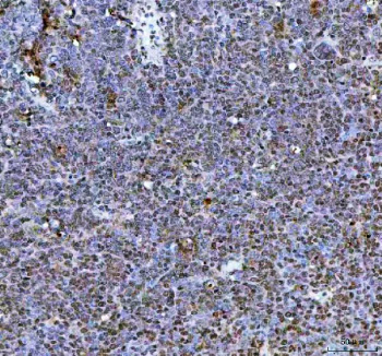 Immunohistochemical staining of NR1D2 using anti-NR1D2 antibody. NR1D2 was detected in a paraffin-embedded section of human cancer tissue. Heat mediated antigen retrieval was performed in EDTA buffer (pH 8.0, epitope retrieval solution). The tissue section was blocked with 10% goat serum. The tissue section was then incubated with 2 ug/ml rabbit anti-NR1D2 antibody overnight at 4oC. Peroxidase Conjugated Goat Anti-rabbit IgG was used as secondary antibody and incubated for 30 minutes at 37oC. The tissue section was developed using an HRP secondary and DAB substrate.
