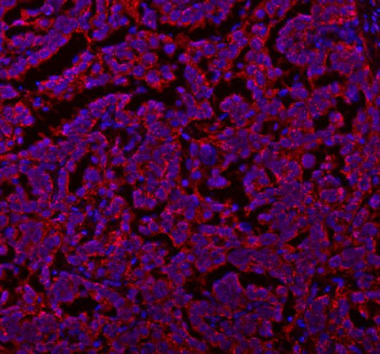 Immunofluorescent staining of SLC7A7 using anti-SLC7A7 antibody (red). SLC7A7 was detected in a paraffin-embedded section of human ovarian cancer tissue. Heat mediated antigen retrieval was performed in EDTA buffer (pH 8.0, epitope retrieval solution). The tissue section was blocked with 10% goat serum. The tissue section was then incubated with 5 ug/ml rabbit anti-SLC7A7 antibody overnight at 4oC. DyLight 594 Conjugated Goat Anti-Rabbit IgG was used as secondary antibody at 1:500 dilution and incubated for 30 minutes at 37oC. The section was counterstained with DAPI nuclear stain (blue). Visualize using a fluorescence microscope and filter sets appropriate for the label used.