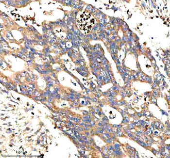 Immunohistochemical staining of STXBP3 using anti-STXBP3 antibody. STXBP3 was detected in a paraffin-embedded section of human colon cancer tissue. Heat mediated antigen retrieval was performed in EDTA buffer (pH 8.0, epitope retrieval solution). The tissue section was blocked with 10% goat serum. The tissue section was then incubated with 2 ug/ml rabbit anti-STXBP3 antibody overnight at 4oC. Peroxidase Conjugated Goat Anti-rabbit IgG was used as secondary antibody and incubated for 30 minutes at 37oC. The tissue section was developed using an HRP secondary and DAB substrate.