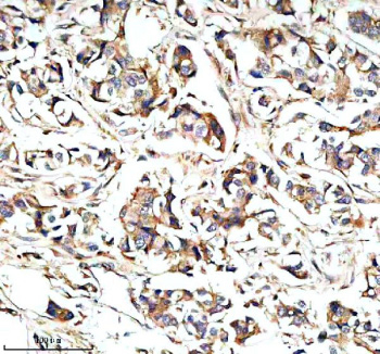 Immunohistochemical staining of STXBP3 using anti-STXBP3 antibody. STXBP3 was detected in a paraffin-embedded section of human breast cancer tissue. Heat mediated antigen retrieval was performed in EDTA buffer (pH 8.0, epitope retrieval solution). The tissue section was blocked with 10% goat serum. The tissue section was then incubated with 2 ug/ml rabbit anti-STXBP3 antibody overnight at 4oC. Peroxidase Conjugated Goat Anti-rabbit IgG was used as secondary antibody and incubated for 30 minutes at 37oC. The tissue section was developed using an HRP secondary and DAB substrate.