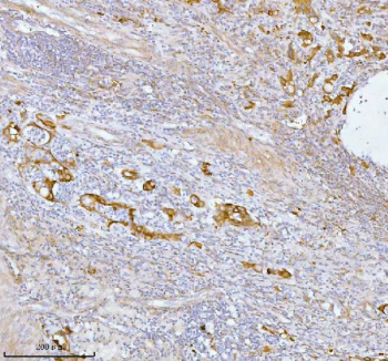 Immunohistochemical staining of SPA17 using anti-SPA17 antibody. SPA17 was detected in a paraffin-embedded section of human rectum adenocarcinoma tissue. Heat mediated antigen retrieval was performed in EDTA buffer (pH 8.0, epitope retrieval solution). The tissue section was blocked with 10% goat serum. The tissue section was then incubated with 2 ug/ml rabbit anti-SPA17 antibody overnight at 4oC. Peroxidase Conjugated Goat Anti-rabbit IgG was used as secondary antibody and incubated for 30 minutes at 37oC. The tissue section was developed using an HRP secondary and DAB substrate.
