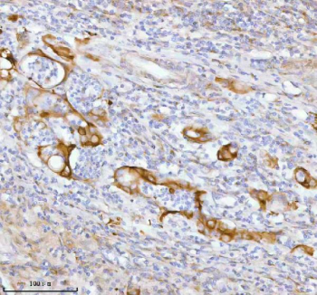 Immunohistochemical staining of SPA17 using anti-SPA17 antibody. SPA17 was detected in a paraffin-embedded section of human rectum adenocarcinoma tissue. Heat mediated antigen retrieval was performed in EDTA buffer (pH 8.0, epitope retrieval solution). The tissue section was blocked with 10% goat serum. The tissue section was then incubated with 2 ug/ml rabbit anti-SPA17 antibody overnight at 4oC. Peroxidase Conjugated Goat Anti-rabbit IgG was used as secondary antibody and incubated for 30 minutes at 37oC. The tissue section was developed using an HRP secondary and DAB substrate.