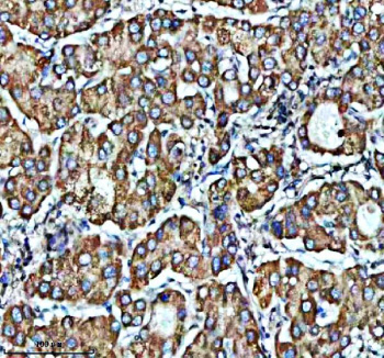 Immunohistochemical staining of PDZD8 using anti-PDZD8 antibody. PDZD8 was detected in a paraffin-embedded section of human liver cancer tissue. Heat mediated antigen retrieval was performed in EDTA buffer (pH 8.0, epitope retrieval solution). The tissue section was blocked with 10% goat serum. The tissue section was then incubated with 2 ug/ml rabbit anti-PDZD8 antibody overnight at 4oC. Peroxidase Conjugated Goat Anti-rabbit IgG was used as secondary antibody and incubated for 30 minutes at 37oC. The tissue section was developed using an HRP secondary and DAB substrate.