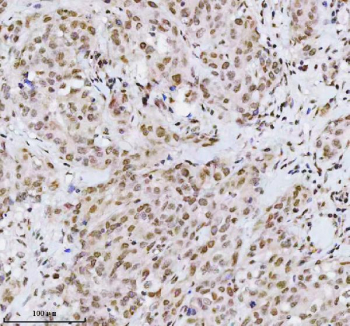 Immunohistochemical staining of MED4 using anti-MED4 antibody. MED4 was detected in a paraffin-embedded section of human breast cancer tissue. Heat mediated antigen retrieval was performed in EDTA buffer (pH 8.0, epitope retrieval solution). The tissue section was blocked with 10% goat serum. The tissue section was then incubated with 2 ug/ml rabbit anti-MED4 antibody overnight at 4oC. Peroxidase Conjugated Goat Anti-rabbit IgG was used as secondary antibody and incubated for 30 minutes at 37oC. The tissue section was developed using an HRP secondary and DAB substrate.