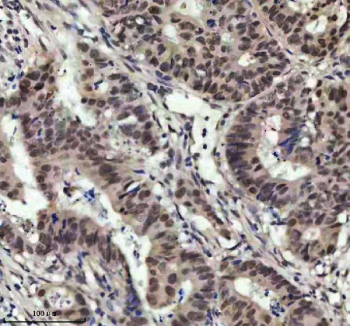 Immunohistochemical staining of MED4 using anti-MED4 antibody. MED4 was detected in a paraffin-embedded section of human rectum adenocarcinoma tissue. Heat mediated antigen retrieval was performed in EDTA buffer (pH 8.0, epitope retrieval solution). The tissue section was blocked with 10% goat serum. The tissue section was then incubated with 2 ug/ml rabbit anti-MED4 antibody overnight at 4oC. Peroxidase Conjugated Goat Anti-rabbit IgG was used as secondary antibody and incubated for 30 minutes at 37oC. The tissue section was developed using an HRP secondary and DAB substrate.