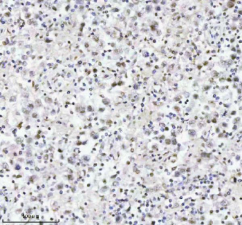 Immunohistochemical staining of MED4 using anti-MED4 antibody. MED4 was detected in a paraffin-embedded section of human testicular seminoma tissue. Heat mediated antigen retrieval was performed in EDTA buffer (pH 8.0, epitope retrieval solution). The tissue section was blocked with 10% goat serum. The tissue section was then incubated with 2 ug/ml rabbit anti-MED4 antibody overnight at 4oC. Peroxidase Conjugated Goat Anti-rabbit IgG was used as secondary antibody and incubated for 30 minutes at 37oC. The tissue section was developed using an HRP secondary and DAB substrate.