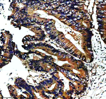 Immunohistochemical staining of NAV1 using anti-NAV1 antibody. NAV1 was detected in a paraffin-embedded section of human colon cancer tissue. Heat mediated antigen retrieval was performed in EDTA buffer (pH 8.0, epitope retrieval solution). The tissue section was blocked with 10% goat serum. The tissue section was then incubated with 2 ug/ml rabbit anti-NAV1 antibody overnight at 4oC. Peroxidase Conjugated Goat Anti-rabbit IgG was used as secondary antibody and incubated for 30 minutes at 37oC. The tissue section was developed using an HRP secondary and DAB substrate.