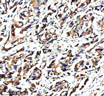 Immunohistochemical staining of NAV1 using anti-NAV1 antibody. NAV1 was detected in a paraffin-embedded section of human breast cancer tissue. Heat mediated antigen retrieval was performed in EDTA buffer (pH 8.0, epitope retrieval solution). The tissue section was blocked with 10% goat serum. The tissue section was then incubated with 2 ug/ml rabbit anti-NAV1 antibody overnight at 4oC. Peroxidase Conjugated Goat Anti-rabbit IgG was used as secondary antibody and incubated for 30 minutes at 37oC. The tissue section was developed using an HRP secondary and DAB substrate.