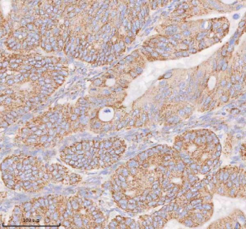 Immunohistochemical staining of COQ8B using anti-COQ8B antibody. COQ8B was detected in a paraffin-embedded section of human ovarian cancer tissue. Heat mediated antigen retrieval was performed in EDTA buffer (pH 8.0, epitope retrieval solution). The tissue section was blocked with 10% goat serum. The tissue section was then incubated with 2 ug/ml rabbit anti-COQ8B antibody overnight at 4oC. Peroxidase Conjugated Goat Anti-rabbit IgG was used as secondary antibody and incubated for 30 minutes at 37oC. The tissue section was developed using an HRP secondary and DAB substrate.