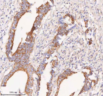 Immunohistochemical staining of COQ8B using anti-COQ8B antibody. COQ8B was detected in a paraffin-embedded section of human rectum adenocarcinoma tissue. Heat mediated antigen retrieval was performed in EDTA buffer (pH 8.0, epitope retrieval solution). The tissue section was blocked with 10% goat serum. The tissue section was then incubated with 2 ug/ml rabbit anti-COQ8B antibody overnight at 4oC. Peroxidase Conjugated Goat Anti-rabbit IgG was used as secondary antibody and incubated for 30 minutes at 37oC. The tissue section was developed using an HRP secondary and DAB substrate.