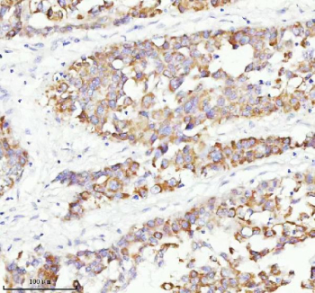 Immunohistochemical staining of RGL3 using anti-RGL3 antibody. RGL3 was detected in a paraffin-embedded section of human liver cancer tissue. Heat mediated antigen retrieval was performed in EDTA buffer (pH 8.0, epitope retrieval solution). The tissue section was blocked with 10% goat serum. The tissue section was then incubated with 2 ug/ml rabbit anti-RGL3 antibody overnight at 4oC. Peroxidase Conjugated Goat Anti-rabbit IgG was used as secondary antibody and incubated for 30 minutes at 37oC. The tissue section was developed using an HRP secondary and DAB substrate.