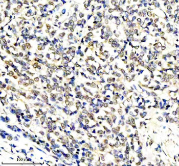 Immunohistochemical staining of RERE using anti-RERE antibody. RERE was detected in a paraffin-embedded section of human breast cancer tissue. Heat mediated antigen retrieval was performed in EDTA buffer (pH 8.0, epitope retrieval solution). The tissue section was blocked with 10% goat serum. The tissue section was then incubated with 2 ug/ml rabbit anti-RERE antibody overnight at 4oC. Peroxidase Conjugated Goat Anti-rabbit IgG was used as secondary antibody and incubated for 30 minutes at 37oC. The tissue section was developed using an HRP secondary and DAB substrate.