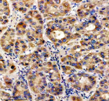Immunohistochemical staining of UBE2W using anti-UBE2W antibody. UBE2W was detected in a paraffin-embedded section of human liver cancer tissue. Heat mediated antigen retrieval was performed in EDTA buffer (pH 8.0, epitope retrieval solution). The tissue section was blocked with 10% goat serum. The tissue section was then incubated with 2 ug/ml rabbit anti-UBE2W antibody overnight at 4oC. Peroxidase Conjugated Goat Anti-rabbit IgG was used as secondary antibody and incubated for 30 minutes at 37oC. The tissue section was developed using an HRP secondary and DAB substrate.