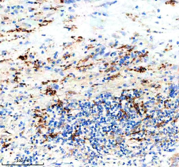 Immunohistochemical staining of PTPRE using anti-PTPRE antibody. PTPRE was detected in a paraffin-embedded section of human liver cancer tissue. Heat mediated antigen retrieval was performed in EDTA buffer (pH 8.0, epitope retrieval solution). The tissue section was blocked with 10% goat serum. The tissue section was then incubated with 2 ug/ml rabbit anti-PTPRE antibody overnight at 4oC. Peroxidase Conjugated Goat Anti-rabbit IgG was used as secondary antibody and incubated for 30 minutes at 37oC. The tissue section was developed using an HRP secondary and DAB substrate.