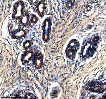 Immunohistochemical staining of PTPRE using anti-PTPRE antibody. PTPRE was detected in a paraffin-embedded section of human breast cancer tissue. Heat mediated antigen retrieval was performed in EDTA buffer (pH 8.0, epitope retrieval solution). The tissue section was blocked with 10% goat serum. The tissue section was then incubated with 2 ug/ml rabbit anti-PTPRE antibody overnight at 4oC. Peroxidase Conjugated Goat Anti-rabbit IgG was used as secondary antibody and incubated for 30 minutes at 37oC. The tissue section was developed using an HRP secondary and DAB substrate.