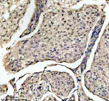 Immunohistochemical staining of EIF4A3 using anti-EIF4A3 antibody. EIF4A3 was detected in a paraffin-embedded section of human cervical cancer tissue. Heat mediated antigen retrieval was performed in EDTA buffer (pH 8.0, epitope retrieval solution). The tissue section was blocked with 10% goat serum. The tissue section was then incubated with 2 ug/ml rabbit anti-EIF4A3 antibody overnight at 4oC. Peroxidase Conjugated Goat Anti-rabbit IgG was used as secondary antibody and incubated for 30 minutes at 37oC. The tissue section was developed using an HRP secondary and DAB substrate.