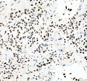 Immunohistochemical staining of PRDM11 using anti-PRDM11 antibody. PRDM11 was detected in a paraffin-embedded section of human lung cancer tissue. Heat mediated antigen retrieval was performed in EDTA buffer (pH 8.0, epitope retrieval solution). The tissue section was blocked with 10% goat serum. The tissue section was then incubated with 2 ug/ml rabbit anti-PRDM11 antibody overnight at 4oC. Peroxidase Conjugated Goat Anti-rabbit IgG was used as secondary antibody and incubated for 30 minutes at 37oC. The tissue section was developed using an HRP secondary and DAB substrate.