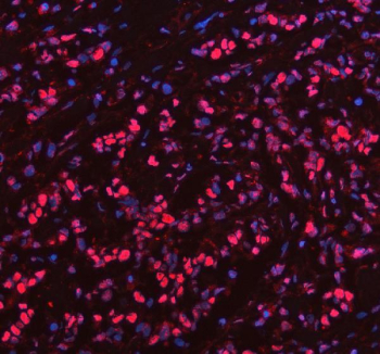 Immunofluorescent staining of PRDM11 using anti-PRDM11 antibody (red). PRDM11 was detected in a paraffin-embedded section of human breast cancer tissue. Heat mediated antigen retrieval was performed in EDTA buffer (pH 8.0, epitope retrieval solution). The tissue section was blocked with 10% goat serum. The tissue section was then incubated with 5 ug/ml rabbit anti-PRDM11 antibody overnight at 4oC. Cy3 Conjugated Goat Anti-Rabbit IgG was used as secondary antibody at 1:500 dilution and incubated for 30 minutes at 37oC. The section was counterstained with DAPI nuclear stain (blue). Visualize using a fluorescence microscope and filter sets appropriate for the label used.