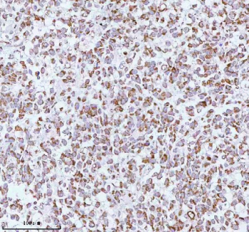 Immunohistochemical staining of using anti-ME3 antibody. ME3 was detected in a paraffin-embedded section of human testicular seminoma tissue. Heat mediated antigen retrieval was performed in EDTA buffer (pH 8.0, epitope retrieval solution). The tissue section was blocked with 10% goat serum. The tissue section was then incubated with 2 ug/ml rabbit anti-ME3 antibody overnight at 4oC. Peroxidase Conjugated Goat Anti-rabbit IgG was used as secondary antibody and incubated for 30 minutes at 37oC. The tissue section was developed using an HRP secondary and DAB substrate.