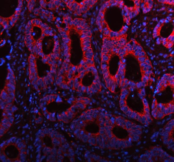 Immunofluorescent staining of FFPE human colon cancer tissue with ME3 antibody (red) and DAPI nuclear stain (blue). HIER: steam section in pH8 EDTA buffer for 20 min.