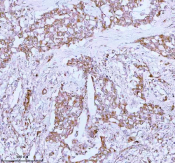 Immunohistochemical staining of using anti-ME3 antibody. ME3 was detected in a paraffin-embedded section of human lung adenocarcinoma tissue. Heat mediated antigen retrieval was performed in EDTA buffer (pH 8.0, epitope retrieval solution). The tissue section was blocked with 10% goat serum. The tissue section was then incubated with 2 ug/ml rabbit anti-ME3 antibody overnight at 4oC. Peroxidase Conjugated Goat Anti-rabbit IgG was used as secondary antibody and incubated for 30 minutes at 37oC. The tissue section was developed using an HRP secondary and DAB substrate.