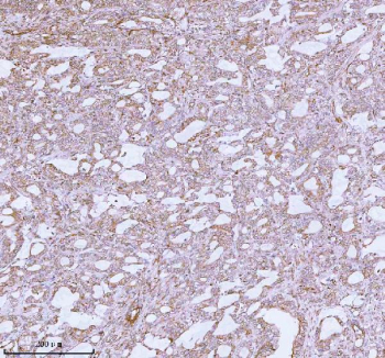 Immunohistochemical staining of using anti-ME3 antibody. ME3 was detected in a paraffin-embedded section of human prostate adenocarcinoma tissue. Heat mediated antigen retrieval was performed in EDTA buffer (pH 8.0, epitope retrieval solution). The tissue section was blocked with 10% goat serum. The tissue section was then incubated with 2 ug/ml rabbit anti-ME3 antibody overnight at 4oC. Peroxidase Conjugated Goat Anti-rabbit IgG was used as secondary antibody and incubated for 30 minutes at 37oC. The tissue section was developed using an HRP secondary and DAB substrate.