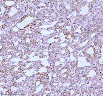 Immunohistochemical staining of using anti-ME3 antibody. ME3 was detected in a paraffin-embedded section of human prostate adenocarcinoma tissue. Heat mediated antigen retrieval was performed in EDTA buffer (pH 8.0, epitope retrieval solution). The tissue section was blocked with 10% goat serum. The tissue section was then incubated with 2 ug/ml rabbit anti-ME3 antibody overnight at 4oC. Peroxidase Conjugated Goat Anti-rabbit IgG was used as secondary antibody and incubated for 30 minutes at 37oC. The tissue section was developed using an HRP secondary and DAB substrate.