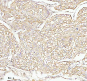 Immunohistochemical staining of TAS2R10 using anti-TAS2R10 antibody. TAS2R10 was detected in a paraffin-embedded section of human cervix squamous cell carcinoma tissue. Heat mediated antigen retrieval was performed in EDTA buffer (pH 8.0, epitope retrieval solution). The tissue section was blocked with 10% goat serum. The tissue section was then incubated with 2 ug/ml rabbit anti-TAS2R10 antibody overnight at 4oC. Peroxidase Conjugated Goat Anti-rabbit IgG was used as secondary antibody and incubated for 30 minutes at 37oC. The tissue section was developed using an HRP secondary and DAB substrate.