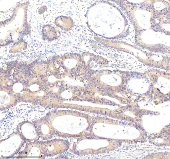 Immunohistochemical staining of HSPA4 using anti-HSPA4 antibody. HSPA4 was detected in a paraffin-embedded section of human colon cancer tissue. Heat mediated antigen retrieval was performed in EDTA buffer (pH 8.0, epitope retrieval solution). The tissue section was blocked with 10% goat serum. The tissue section was then incubated with 2 ug/ml rabbit anti-HSPA4 antibody overnight at 4oC. Peroxidase Conjugated Goat Anti-rabbit IgG was used as secondary antibody and incubated for 30 minutes at 37oC. The tissue section was developed using an HRP secondary and DAB substrate.