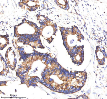 Immunohistochemical staining of MATK using anti-MATK antibody. MATK was detected in a paraffin-embedded section of human colon cancer tissue. Heat mediated antigen retrieval was performed in EDTA buffer (pH 8.0, epitope retrieval solution). The tissue section was blocked with 10% goat serum. The tissue section was then incubated with 2 ug/ml rabbit anti-MATK antibody overnight at 4oC. Peroxidase Conjugated Goat Anti-rabbit IgG was used as secondary antibody and incubated for 30 minutes at 37oC. The tissue section was developed using an HRP secondary and DAB substrate.