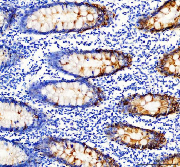 Immunohistochemical staining of Cytokeratin 20 using anti-KRT20 antibody. KRT20 was detected in a paraffin-embedded section of human colon cancer tissue. Heat mediated antigen retrieval was performed in EDTA buffer (pH 8.0, epitope retrieval solution). The tissue section was blocked with 10% goat serum. The tissue section was then incubated with 2 ug/ml rabbit anti-KRT20 antibody overnight at 4oC. Peroxidase Conjugated Goat Anti-rabbit IgG was used as secondary antibody and incubated for 30 minutes at 37oC. The tissue section was developed using an HRP secondary and DAB substrate.