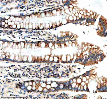 Immunohistochemical staining of NUDT8 using anti-NUDT8 antibody. NUDT8 was detected in a paraffin-embedded section of human colon cancer tissue. Heat mediated antigen retrieval was performed in EDTA buffer (pH 8.0, epitope retrieval solution). The tissue section was blocked with 10% goat serum. The tissue section was then incubated with 2 ug/ml rabbit anti-NUDT8 antibody overnight at 4oC. Peroxidase Conjugated Goat Anti-rabbit IgG was used as secondary antibody and incubated for 30 minutes at 37oC. The tissue section was developed using an HRP secondary and DAB substrate.