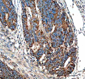 Immunohistochemical staining of NUDT8 using anti-NUDT8 antibody. NUDT8 was detected in a paraffin-embedded section of human colon cancer tissue. Heat mediated antigen retrieval was performed in EDTA buffer (pH 8.0, epitope retrieval solution). The tissue section was blocked with 10% goat serum. The tissue section was then incubated with 2 ug/ml rabbit anti-NUDT8 antibody overnight at 4oC. Peroxidase Conjugated Goat Anti-rabbit IgG was used as secondary antibody and incubated for 30 minutes at 37oC. The tissue section was developed using an HRP secondary and DAB substrate.