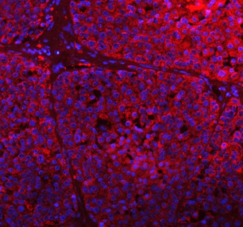GCLC Antibody Liver Cancer IF. Immunofluorescent staining of FFPE human liver carcinoma tissue using GCLC Antibody / Glutathione Biosynthesis Antibody demonstrates widespread cytoplasmic red fluorescence throughout neoplastic hepatic cell populations. The staining pattern is consistent with expression of Glutamate-Cysteine Ligase Catalytic Subunit (GCLC), the rate-limiting enzyme in glutathione biosynthesis and a key regulator of cellular antioxidant defense pathways. Robust cytoplasmic immunoreactivity highlights the high metabolic and redox demands of tumor-associated cells and is consistent with the established role of GCLC in glutathione production, oxidative stress responses, and cellular detoxification mechanisms. Nuclei are visualized with DAPI counterstain (blue). The observed staining demonstrates the utility of this antibody for studies of glutathione metabolism, redox biology, oxidative stress regulation, cancer metabolism, and antioxidant defense pathways. HIER: EDTA buffer, pH 8.0.