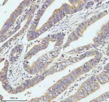 GCLC Antibody Colon Cancer IHC. Immunohistochemical staining of FFPE human colon carcinoma tissue using GCLC Antibody / Glutathione Biosynthesis Antibody demonstrates moderate to strong cytoplasmic HRP-DAB brown staining throughout malignant glandular epithelial cell populations. The staining pattern is consistent with expression of Glutamate-Cysteine Ligase Catalytic Subunit (GCLC), the catalytic component of the rate-limiting enzyme in glutathione biosynthesis and a key regulator of cellular antioxidant defense mechanisms. Prominent immunoreactivity within neoplastic epithelial structures is consistent with the established role of GCLC in glutathione production, oxidative stress adaptation, detoxification pathways, and metabolic homeostasis. The observed staining demonstrates the utility of this antibody for studies of redox biology, antioxidant defense, cancer metabolism, oxidative stress signaling, and glutathione-dependent cellular protection mechanisms. HIER: EDTA buffer, pH 8.0.
