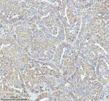 GCLC Antibody Liver Cancer IHC. Immunohistochemical staining of FFPE human liver carcinoma tissue using GCLC Antibody / Glutathione Biosynthesis Antibody demonstrates widespread cytoplasmic HRP-DAB brown staining throughout neoplastic hepatic cell populations. The staining pattern is consistent with expression of Glutamate-Cysteine Ligase Catalytic Subunit (GCLC), the catalytic component of the rate-limiting enzyme in glutathione biosynthesis and a central regulator of cellular antioxidant defense pathways. Diffuse immunoreactivity within tumor cells is consistent with the established role of GCLC in glutathione production, oxidative stress adaptation, detoxification mechanisms, and metabolic homeostasis. The observed staining demonstrates the utility of this antibody for studies of redox biology, cancer metabolism, oxidative stress signaling, antioxidant defense pathways, and glutathione-dependent cellular protection mechanisms. HIER: EDTA buffer, pH 8.0.