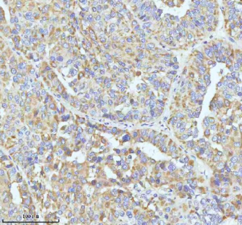 GCLC Antibody Liver Cancer IHC. Immunohistochemical staining of FFPE human liver carcinoma tissue using GCLC Antibody / Glutathione Biosynthesis Antibody demonstrates moderate to strong cytoplasmic HRP-DAB brown staining throughout malignant hepatic cell populations arranged in trabecular and glandular-like growth patterns. The staining profile is consistent with expression of Glutamate-Cysteine Ligase Catalytic Subunit (GCLC), the catalytic component of the rate-limiting enzyme in glutathione biosynthesis and a critical regulator of cellular antioxidant defense mechanisms. Prominent cytoplasmic immunoreactivity within neoplastic cells is consistent with the established role of GCLC in glutathione production, oxidative stress adaptation, xenobiotic detoxification, and metabolic homeostasis. The observed staining demonstrates the utility of this antibody for studies of redox biology, antioxidant defense pathways, cancer metabolism, oxidative stress signaling, and glutathione-dependent cellular protection mechanisms. HIER: EDTA buffer, pH 8.0.