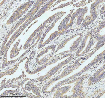 GCLC Antibody Colon Cancer IHC. Immunohistochemical staining of FFPE human colon carcinoma tissue using GCLC Antibody / Glutathione Biosynthesis Antibody demonstrates diffuse cytoplasmic HRP-DAB brown staining throughout malignant gland-forming epithelial cell populations. The staining pattern is consistent with expression of Glutamate-Cysteine Ligase Catalytic Subunit (GCLC), the catalytic component of the rate-limiting enzyme in glutathione biosynthesis and a central regulator of intracellular antioxidant defense pathways. Prominent immunoreactivity within neoplastic epithelial structures is consistent with the established role of GCLC in glutathione production, oxidative stress adaptation, cellular detoxification, and metabolic homeostasis. The observed staining demonstrates the utility of this antibody for studies of redox biology, cancer metabolism, oxidative stress signaling, antioxidant defense mechanisms, and glutathione-dependent cellular protection pathways. HIER: EDTA buffer, pH 8.0.
