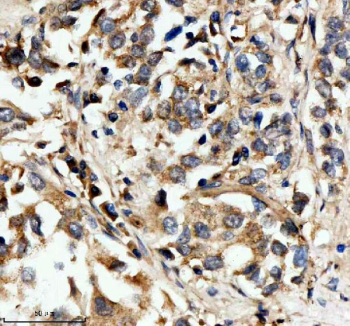 Immunohistochemical staining of HPGD using anti-HPGD antibody. HPGD was detected in a paraffin-embedded section of human lung cancer tissue. Heat mediated antigen retrieval was performed in EDTA buffer (pH 8.0, epitope retrieval solution). The tissue section was blocked with 10% goat serum. The tissue section was then incubated with 2 ug/ml rabbit anti-HPGD antibody overnight at 4oC. Peroxidase Conjugated Goat Anti-rabbit IgG was used as secondary antibody and incubated for 30 minutes at 37oC. The tissue section was developed using an HRP secondary and DAB substrate.