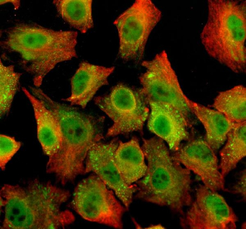 Immunohistochemical staining of HPGD using anti-HPGD antibody. HPGD was detected in a paraffin-embedded section of human breast cancer tissue. Heat mediated antigen retrieval was performed in EDTA buffer (pH 8.0, epitope retrieval solution). The tissue section was blocked with 10% goat serum. The tissue section was then incubated with 2 ug/ml rabbit anti-HPGD antibody overnight at 4oC. Peroxidase Conjugated Goat Anti-rabbit IgG was used as secondary antibody and incubated for 30 minutes at 37oC. The tissue section was developed using an HRP secondary and DAB substrate.