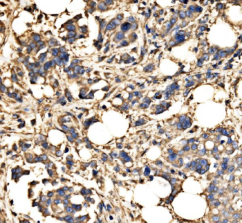 Immunohistochemical staining of FFPE human breast cancer tissue with SRP72 antibody, HRP-secondary and DAB substrate. HIER: boil tissue sections in pH8 EDTA for 20 min and allow to cool before testing.