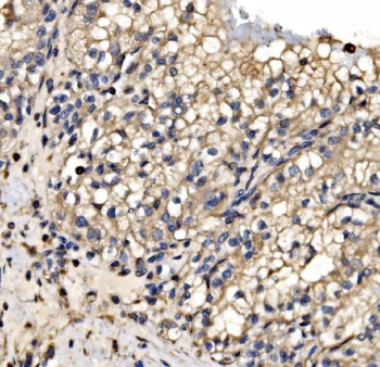 Immunohistochemical staining of FFPE human renal cancer tissue with SRP72 antibody, HRP-secondary and DAB substrate. HIER: boil tissue sections in pH8 EDTA for 20 min and allow to cool before testing.