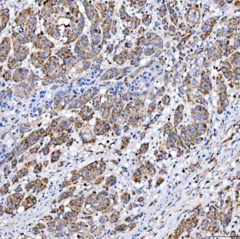 Immunohistochemical staining of FFPE human prostate adenocarcinoma tissue with SUCLG2 antibody, HRP-secondary and DAB substrate. HIER: boil tissue sections in pH8 EDTA for 20 min and allow to cool before testing.