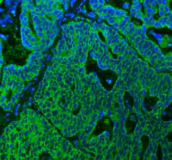 Immunofluorescent staining of FFPE human ovarian cancer tissue with SUCLG2 antibody (green) and DAPI nuclear stain (blue). HIER: steam section in pH8 EDTA buffer for 20 min.