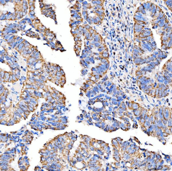 Immunohistochemical staining of FFPE human rectum adenocarcinoma tissue with SUCLG2 antibody, HRP-secondary and DAB substrate. HIER: boil tissue sections in pH8 EDTA for 20 min and allow to cool before testing.