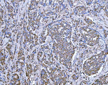 Immunohistochemical staining of FFPE human lung adenocarcinoma tissue with SUCLG2 antibody, HRP-secondary and DAB substrate. HIER: boil tissue sections in pH8 EDTA for 20 min and allow to cool before testing.