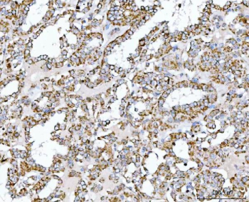 Immunohistochemical staining of FFPE human thyroid papillary carcinoma tissue with SUCLG2 antibody, HRP-secondary and DAB substrate. HIER: boil tissue sections in pH8 EDTA for 20 min and allow to cool before testing.