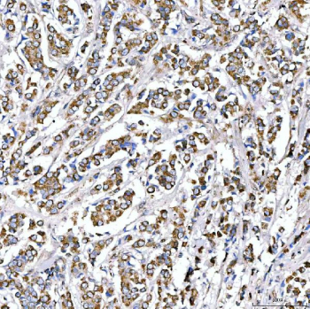 Immunohistochemical staining of FFPE human breast cancer tissue with SUCLG2 antibody, HRP-secondary and DAB substrate. HIER: boil tissue sections in pH8 EDTA for 20 min and allow to cool before testing.
